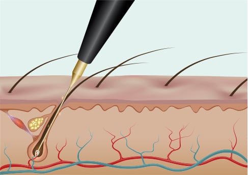 Electrolysis Picture Electrolysis Picture