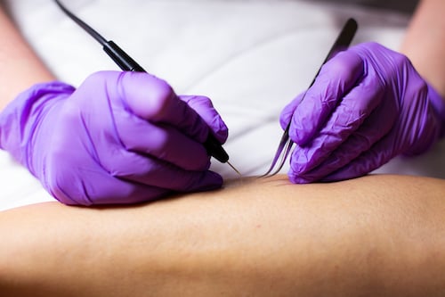 Electrolysis Picture Electrolysis Picture